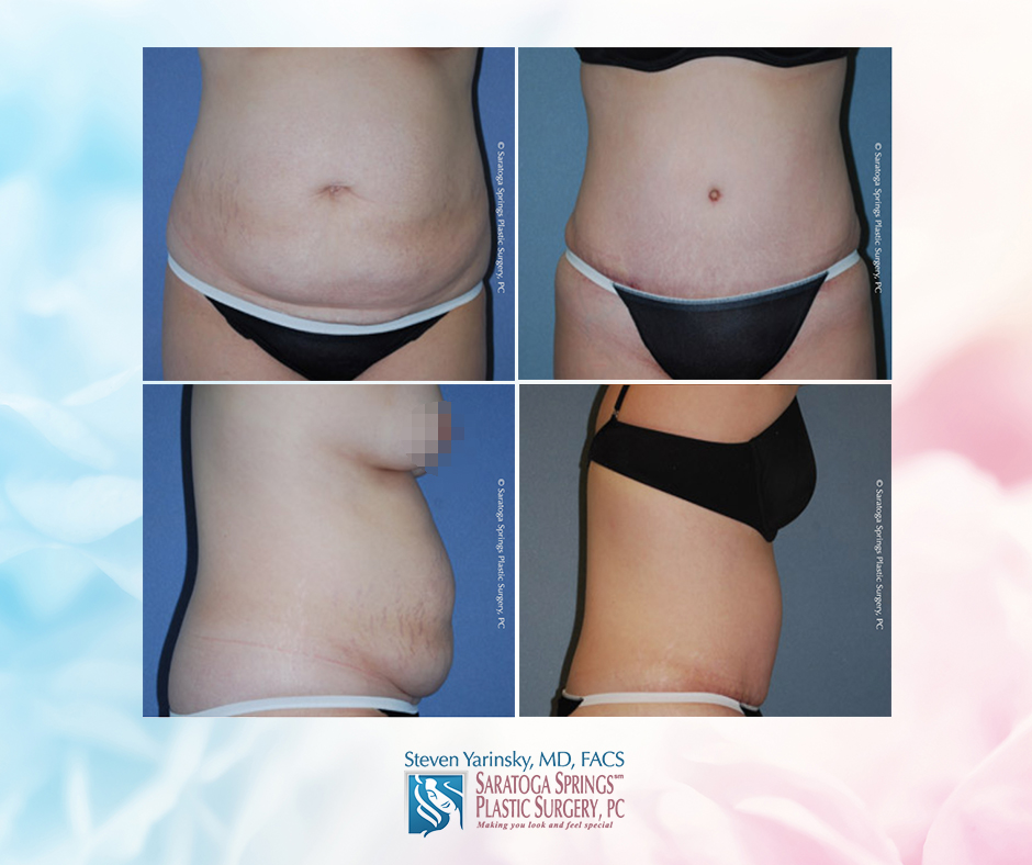 Tummy Tuck (Abdominoplasty) - New York Liposuction Center